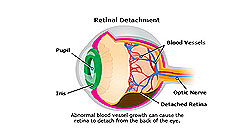 Joseph Eye Hospital (Retinal Detachment)