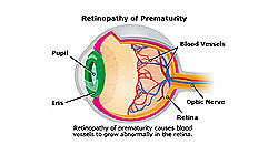 Joseph Eye Hospital Causes of ROP (Retinopathy of prematurity )